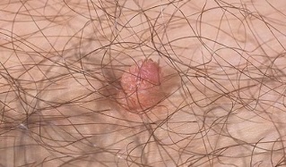 人乳头瘤病毒的传播