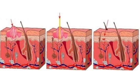 激光如何影响乳头状瘤
